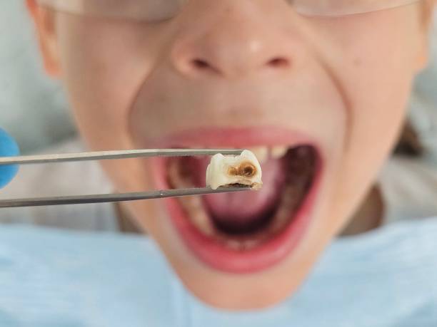 Best Dental Abscess Treatment in Hermann, MO